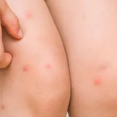 Un niño se rasca las piernas, mostrando pequeños granos rojos que parecen ser causados por el sudor.