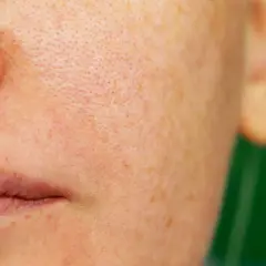 Primer plano de piel con poros visibles y manchas de melasma facial.