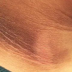 Primer plano de manchas oscuras en el cuello, con la piel arrugada y una textura visible.