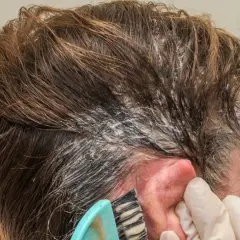 Aplicando producto para el cabello en la raíz. Si te manchas, así es como quitar el tinte de la piel.