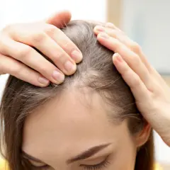 Manos revisan el cuero cabelludo, mostrando áreas de cabello fino. La vitamina D es buena para el pelo, ayudando a fortalecerlo.