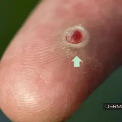 Un grano enquistado en un dedo, con una flecha verde apuntando a la lesión.