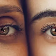 Dos ojos de cerca, uno con ojeras pigmentadas y el otro con piel clara. Reflejo de un fotógrafo en el iris.