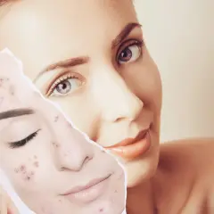 Mujer muestra un trozo de piel con acné, comparándola con su rostro, preguntándose cuánto tarda en regenerarse la piel.