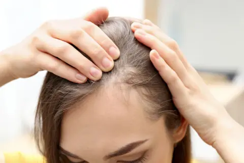 Manos revisan el cuero cabelludo, mostrando áreas de cabello fino. La vitamina D es buena para el pelo, ayudando a fortalecerlo.