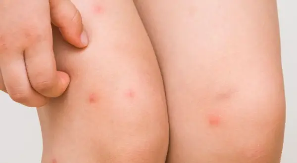Un niño se rasca las piernas, mostrando pequeños granos rojos que parecen ser causados por el sudor.