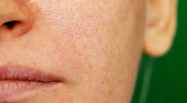 Primer plano de piel con poros visibles y manchas de melasma facial.