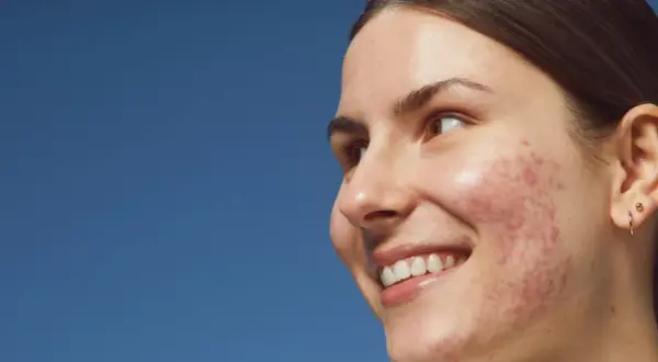 Sonrisa radiante de una joven con acné, buscando soluciones para quitar granos y lucir una piel sana.