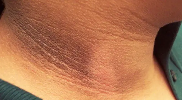 Primer plano de manchas oscuras en el cuello, con la piel arrugada y una textura visible.