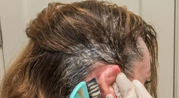 Aplicando producto para el cabello en la raíz. Si te manchas, así es como quitar el tinte de la piel.