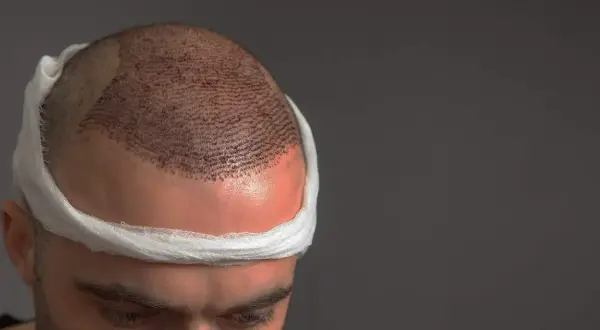 Hombre con vendaje en la cabeza tras trasplante capilar. Se aprecian los injertos para un pelo normal.
