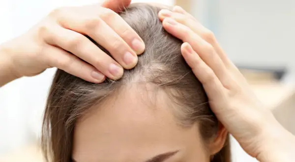Manos revisan el cuero cabelludo, mostrando áreas de cabello fino. La vitamina D es buena para el pelo, ayudando a fortalecerlo.