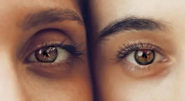 Dos ojos de cerca, uno con ojeras pigmentadas y el otro con piel clara. Reflejo de un fotógrafo en el iris.