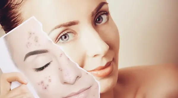 Mujer muestra un trozo de piel con acné, comparándola con su rostro, preguntándose cuánto tarda en regenerarse la piel.