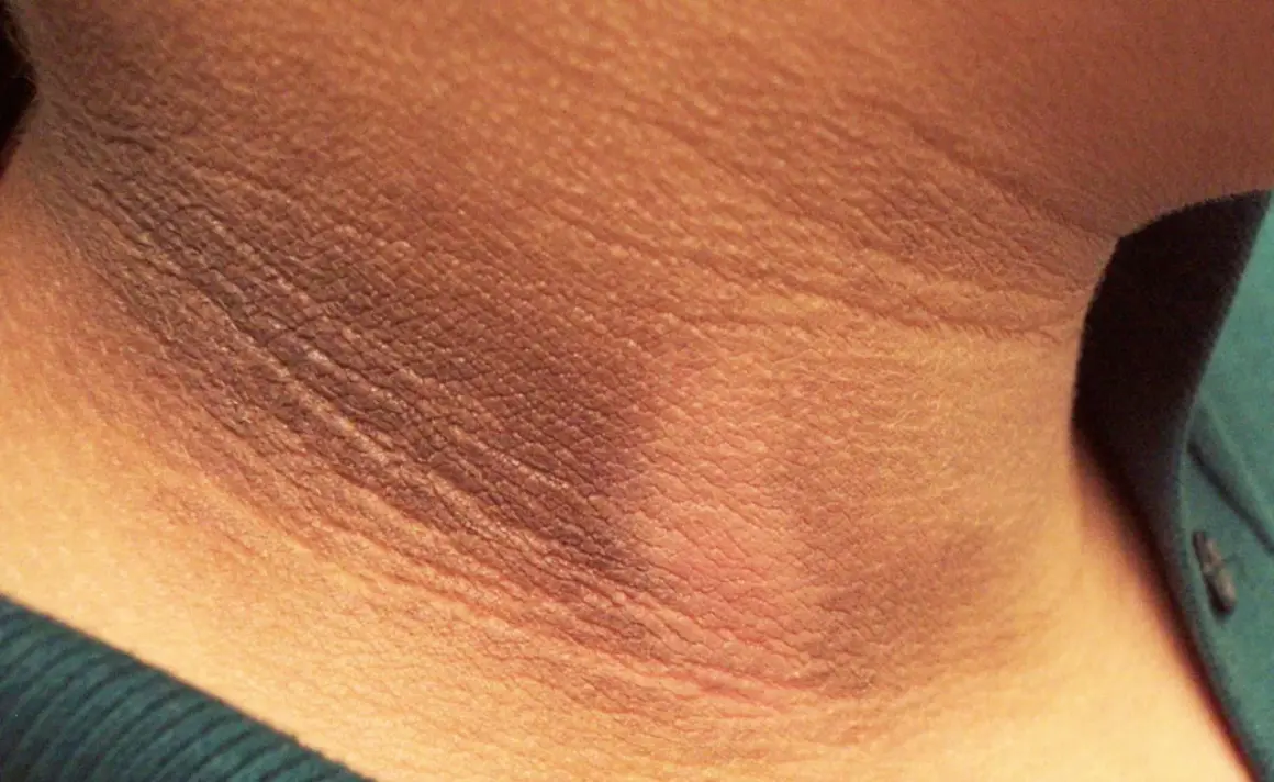 Primer plano de manchas oscuras en el cuello, con la piel arrugada y una textura visible.