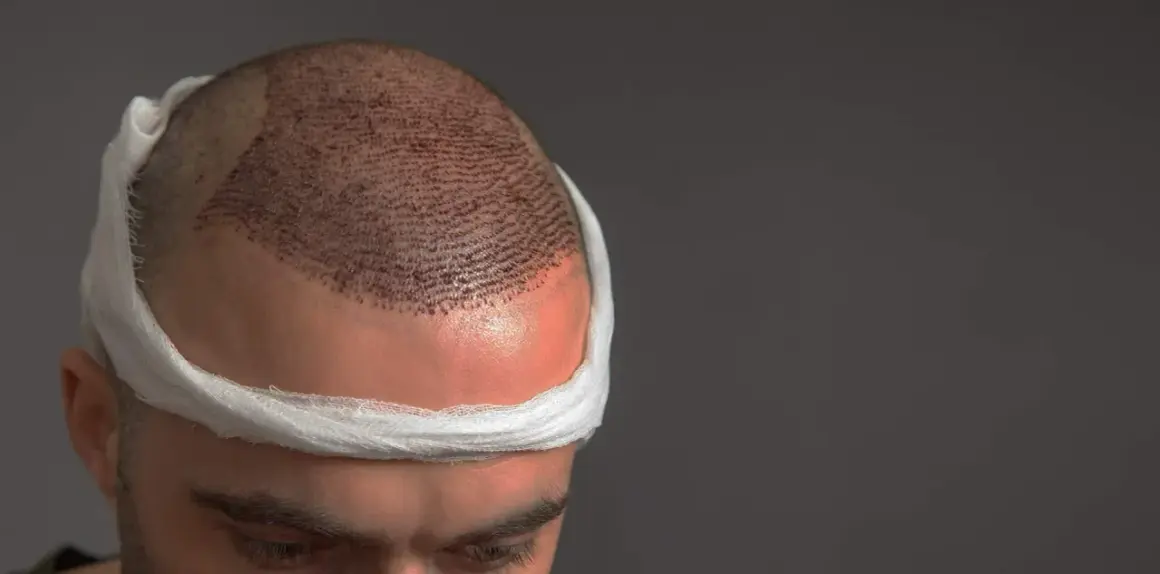 Hombre con vendaje en la cabeza tras trasplante capilar. Se aprecian los injertos para un pelo normal.