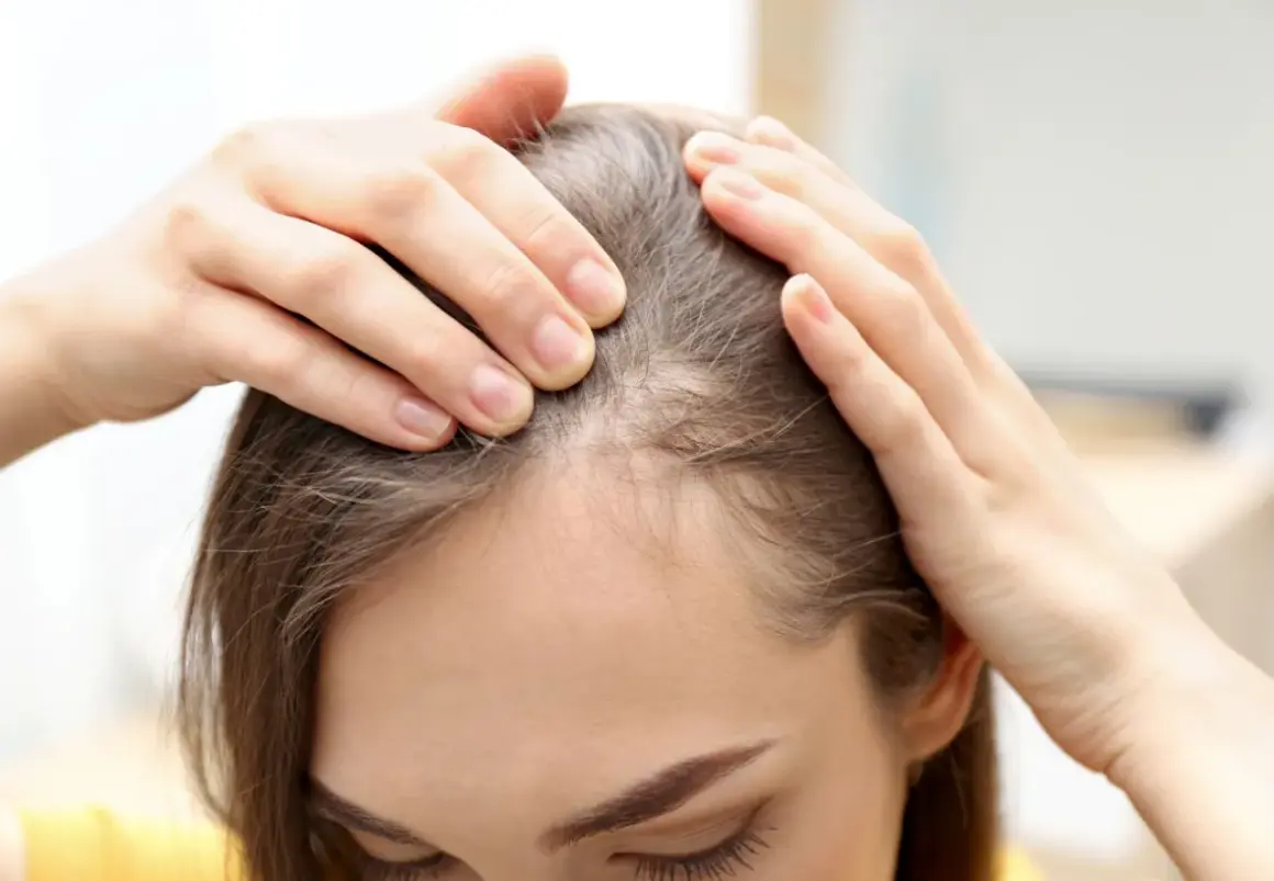 Manos revisan el cuero cabelludo, mostrando áreas de cabello fino. La vitamina D es buena para el pelo, ayudando a fortalecerlo.
