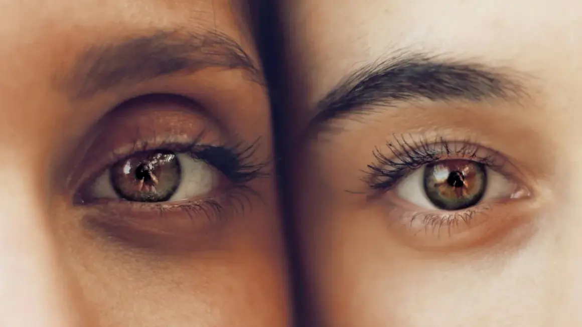 Dos ojos de cerca, uno con ojeras pigmentadas y el otro con piel clara. Reflejo de un fotógrafo en el iris.