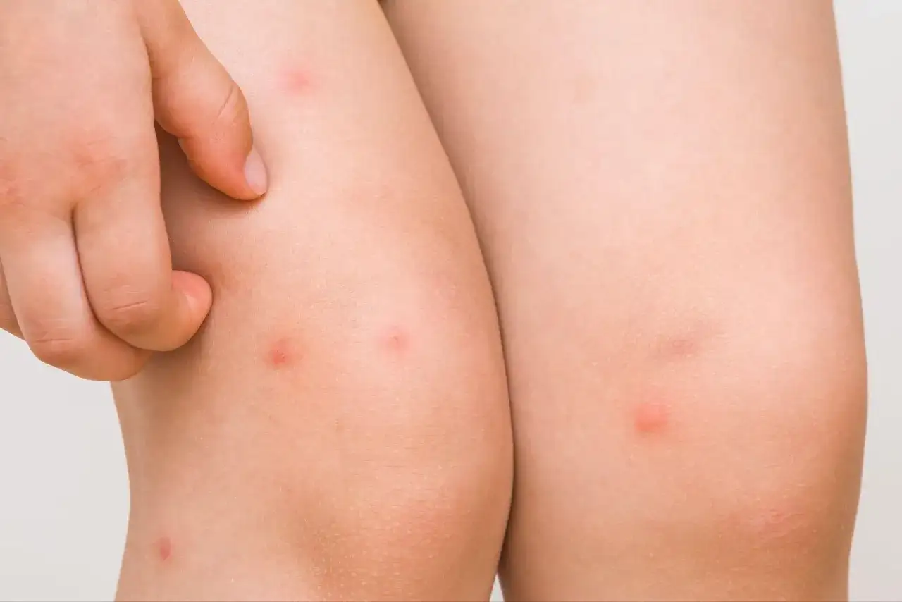 Granos por sudor - ¿Acné, miliaria o foliculitis? Soluciones efectivas