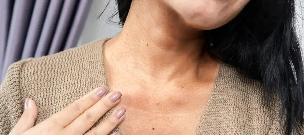Primer plano del cuello de una mujer con manchas, mostrando la textura de la piel y un suéter beige.
