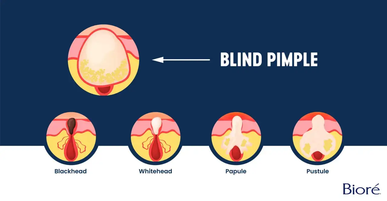 Ilustración de un grano ciego y su evolución: blackhead, whitehead, pápula y pústula.