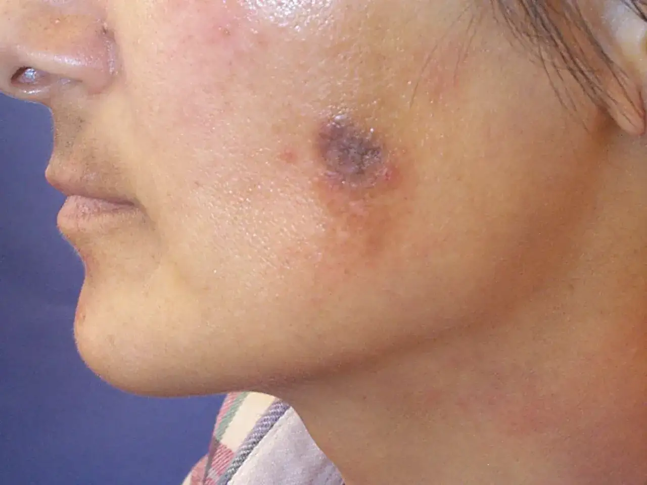 Primer plano de un rostro con un grano inflamado y doloroso en la mejilla.