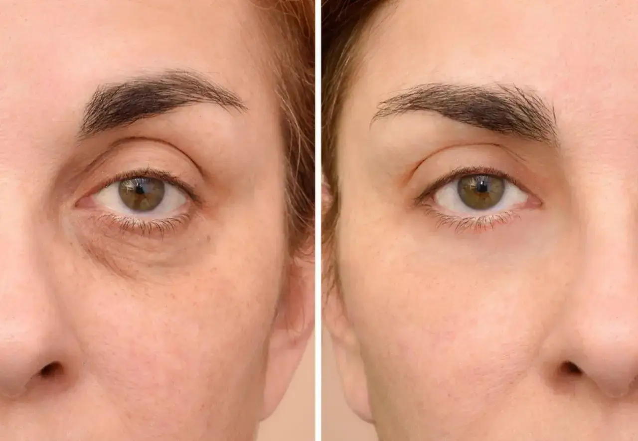 Comparación de ojos: antes con ojeras pigmentadas y bolsas, después con piel más lisa y uniforme.