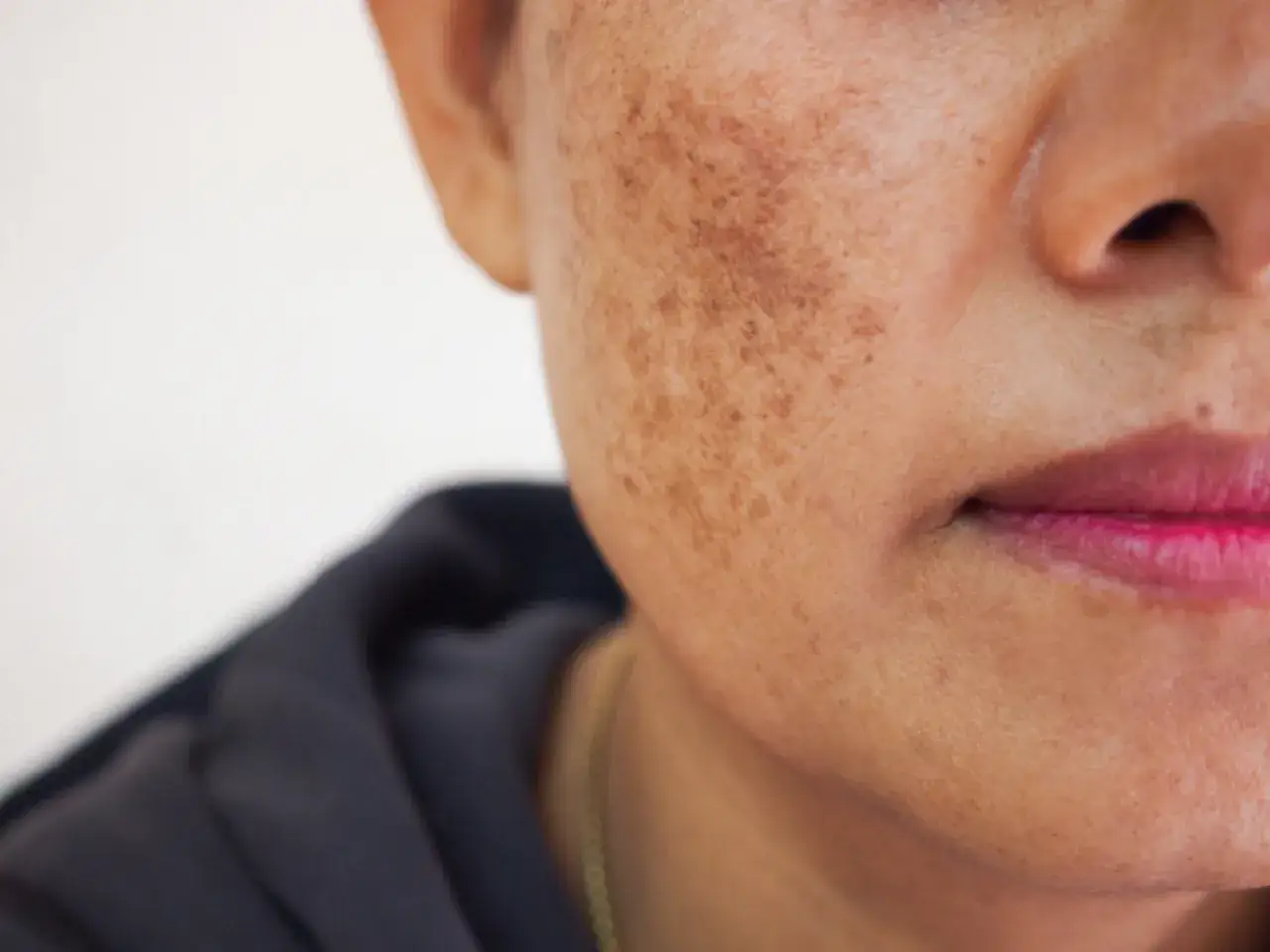 Primer plano de una mejilla con melasma facial, mostrando manchas oscuras y piel con textura.