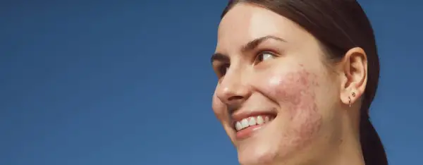Sonrisa radiante de una joven con acné, buscando soluciones para quitar granos y lucir una piel sana.